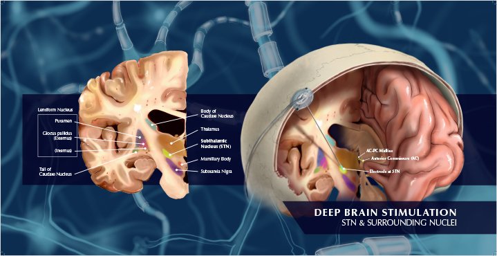 Rogers Deep Brain Stimulation Illustration