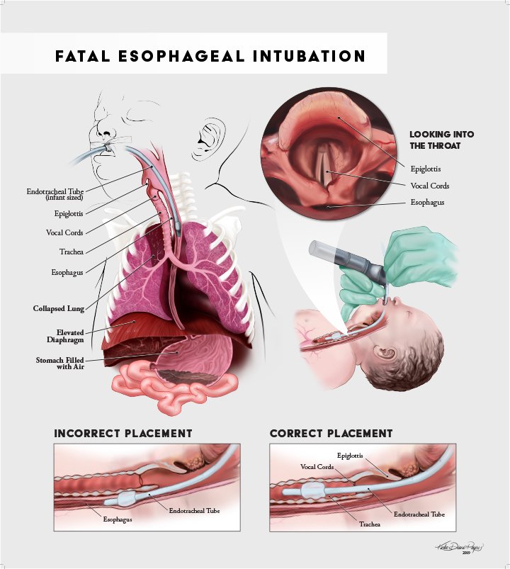 Rogers Esophageal Intubation Plate